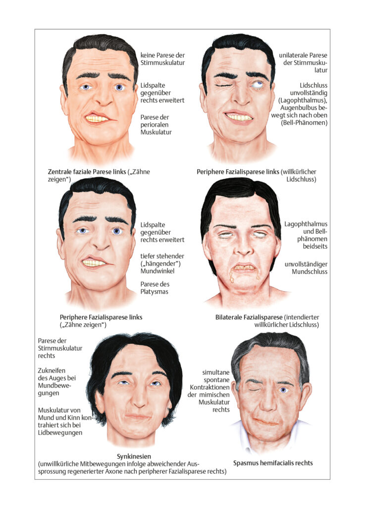 Nervus-facialis-Läsion