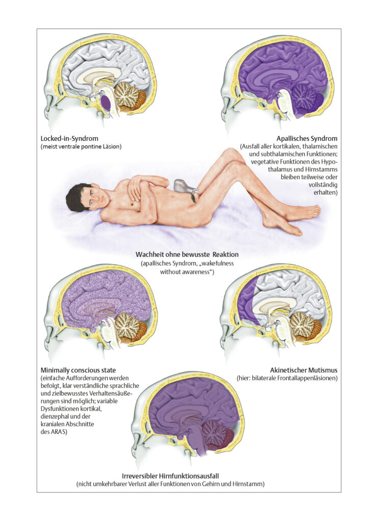 Komaähnliches Syndrom, irreversibler Hirnfunktionsausfall