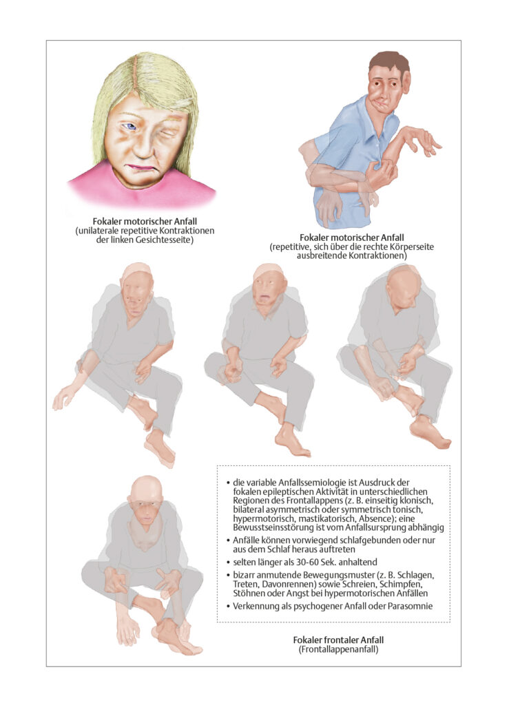 Epilepsien