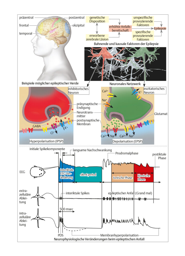 Epilepsien
