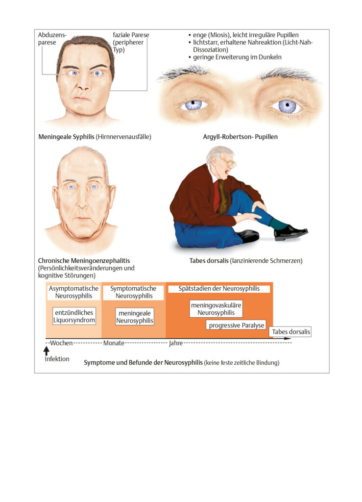 Neurosyphilis