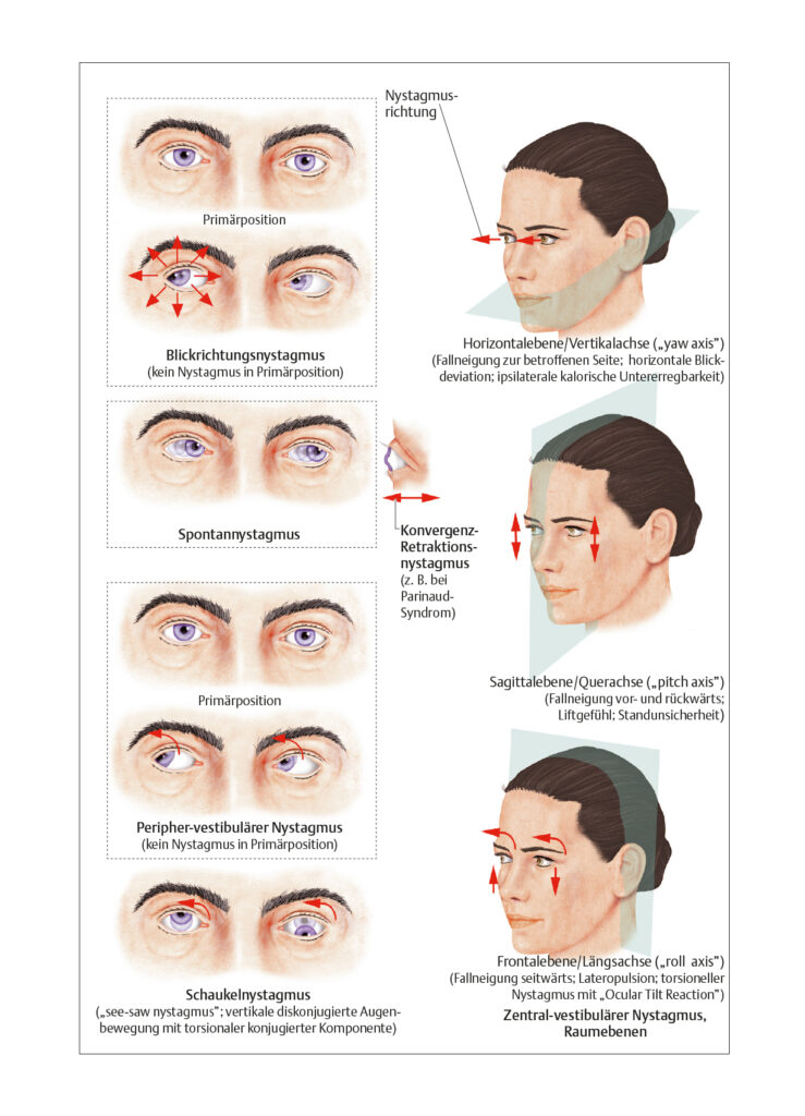 Nystagmus