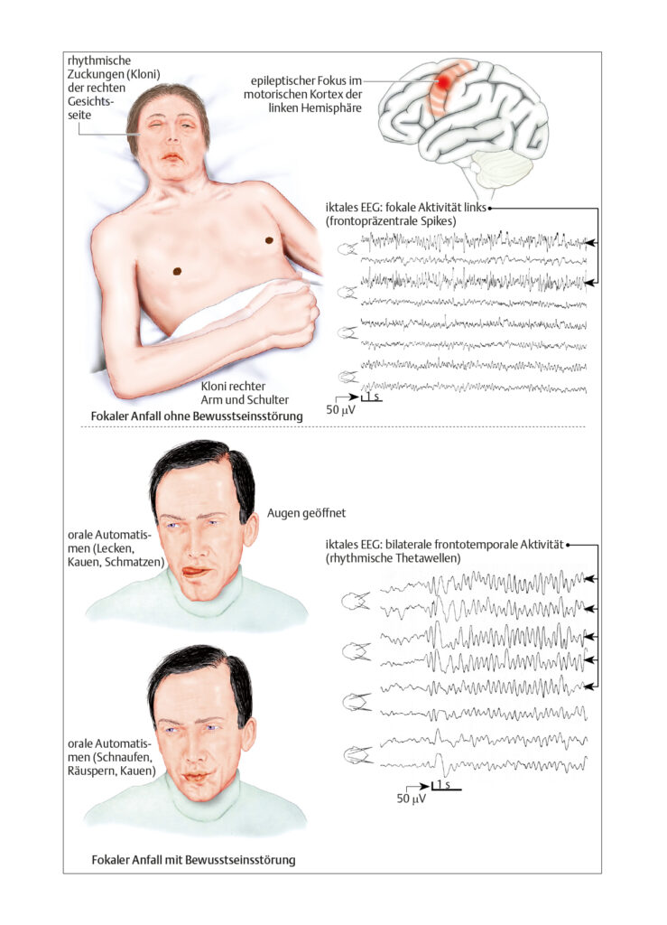 Epileptischer Anfall