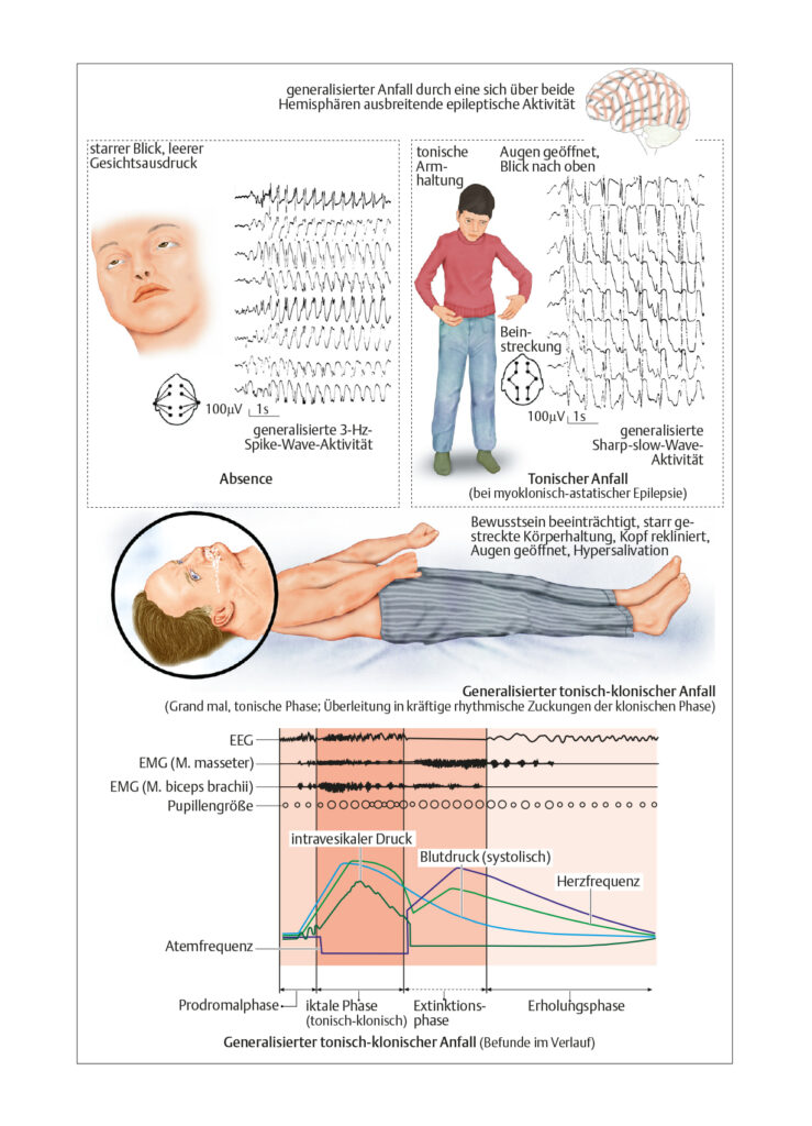 Epileptischer Anfall
