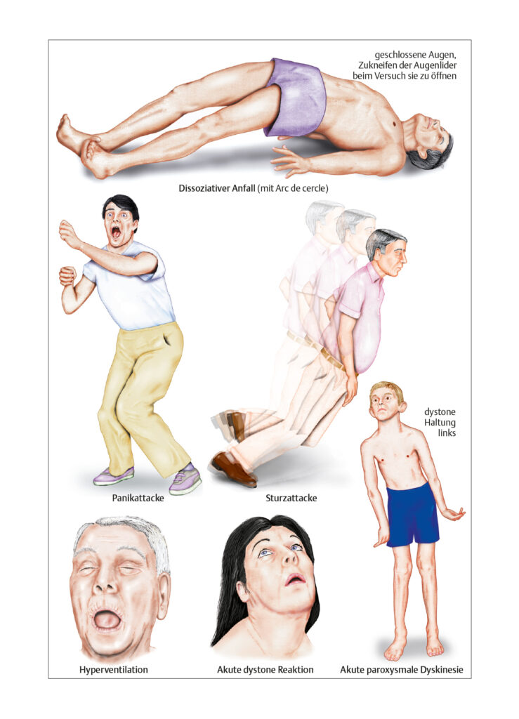 Nichtepileptischer Anfall