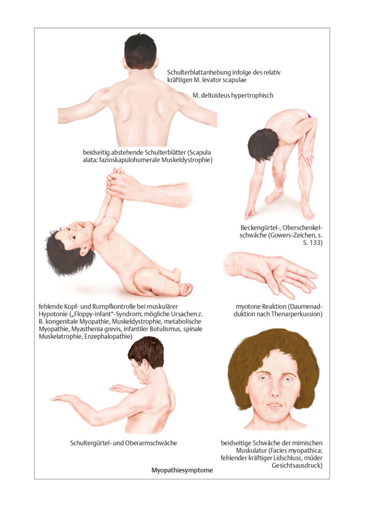 Myopathiesyndrom